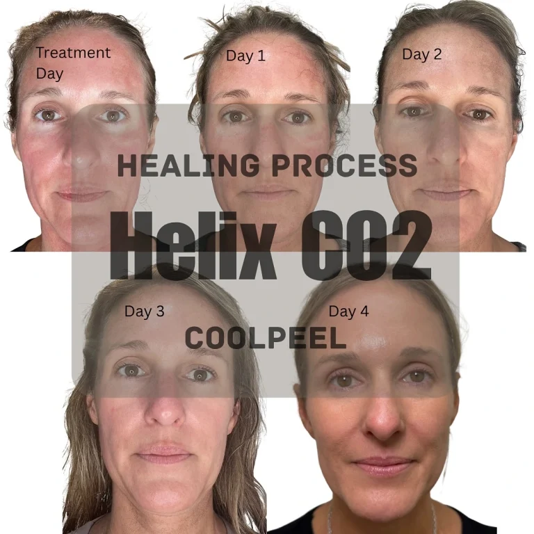 Before-and-after collage showing Helix CO₂ CoolPeel healing from treatment day to day 4, illustrating skin recovery and reduced redness.