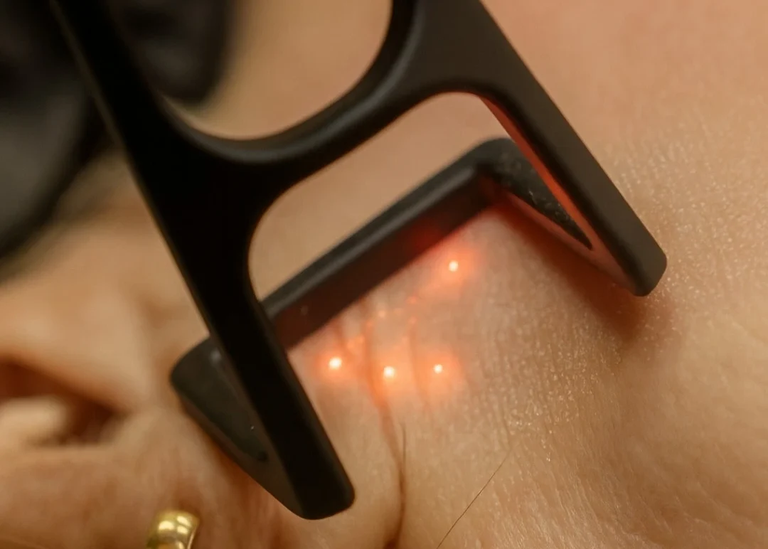 Close-up of Helix CO₂ laser treating skin with precision light dots