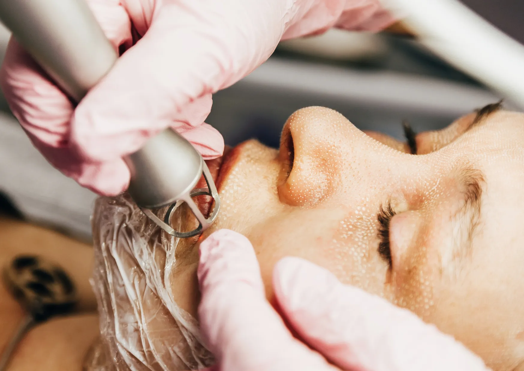 A professional aesthetic clinician doing the CO2 laser at iBeauty Medical.