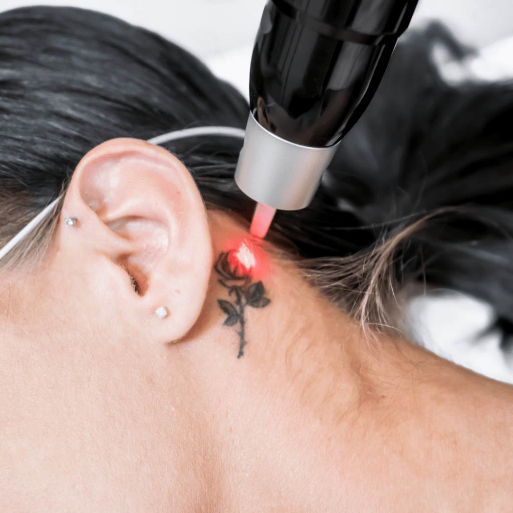 laser tattoo removal