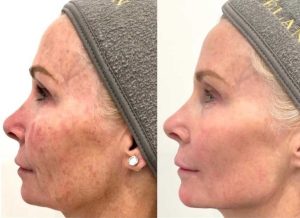 Before-and-after profile view of a woman showing skin texture improvement after CoolPeel CO₂ laser treatment, with smoother tone and reduced discoloration following three sessions.