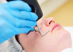Clinician performing HELIX CO₂ laser resurfacing on a patient’s face to treat acne scars and improve skin texture