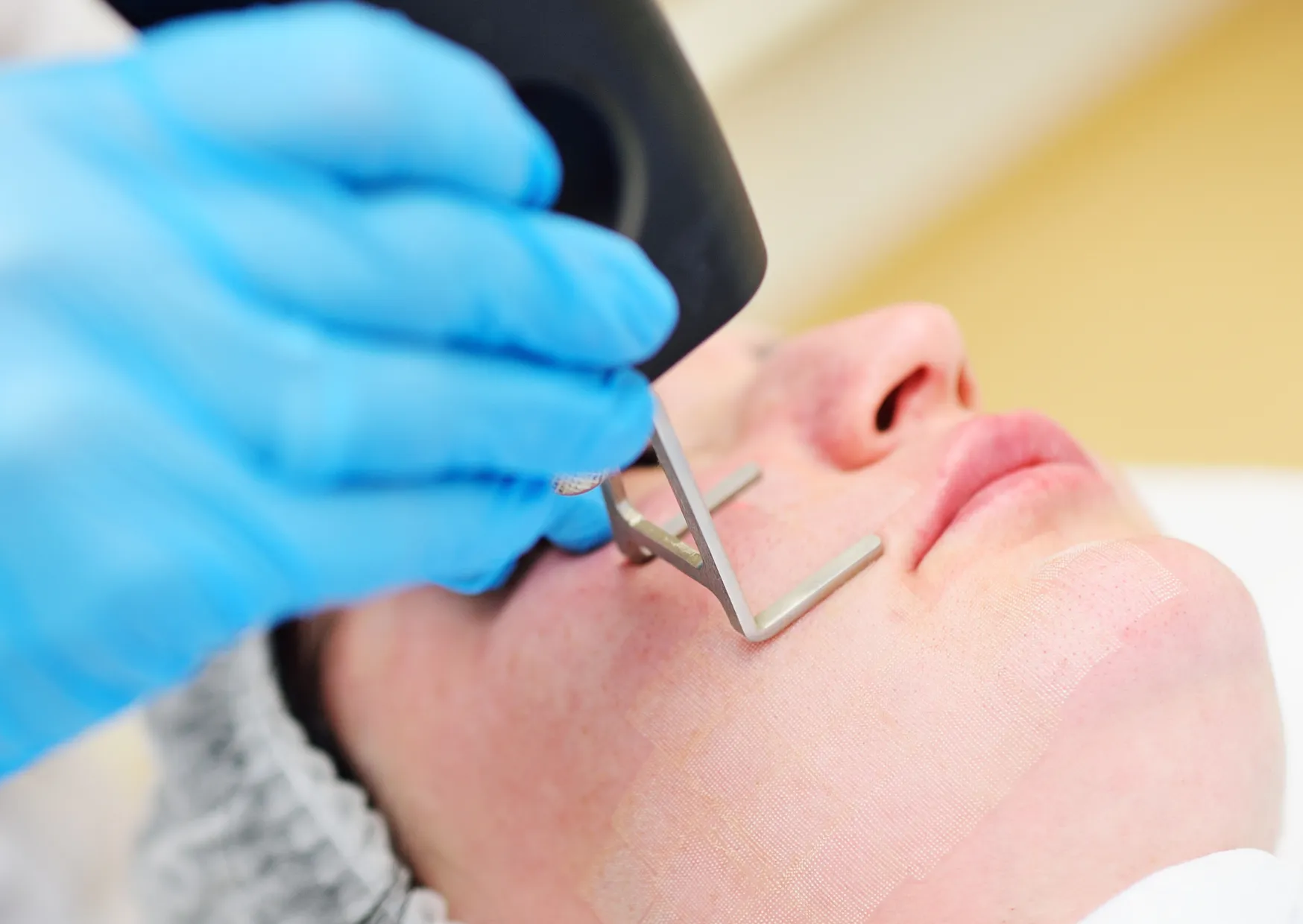 Clinician performing HELIX CO₂ laser resurfacing on a patient’s face to treat acne scars and improve skin texture