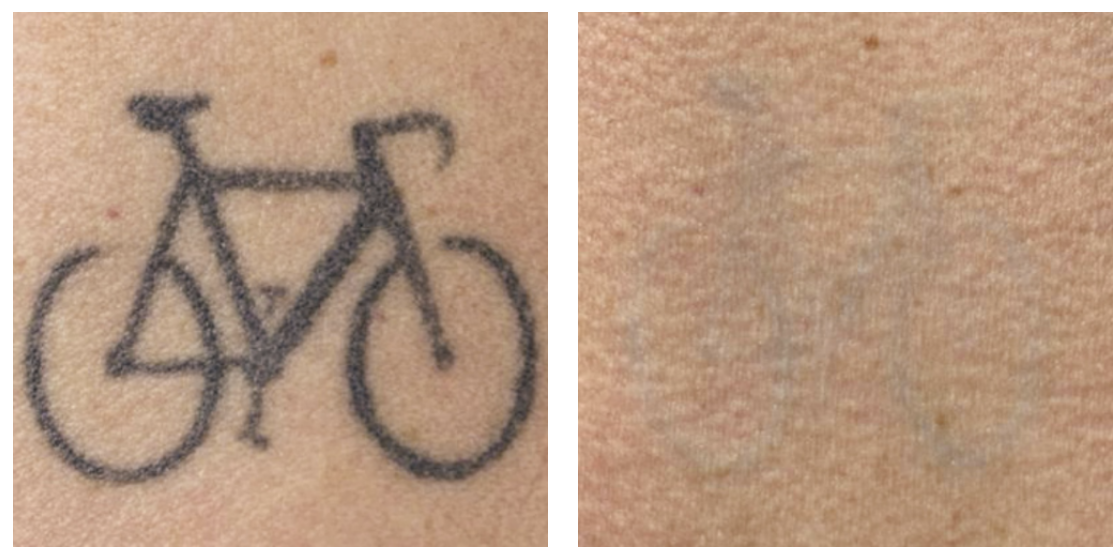 laser tattoo removal before and after