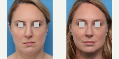 FaceTite before and after laser lipo service