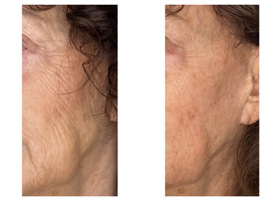 EVERESE SKIN TIGHTENING
