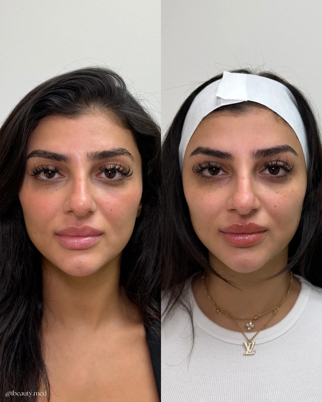 Radiesse is our go to for anti-aging and facial balancing