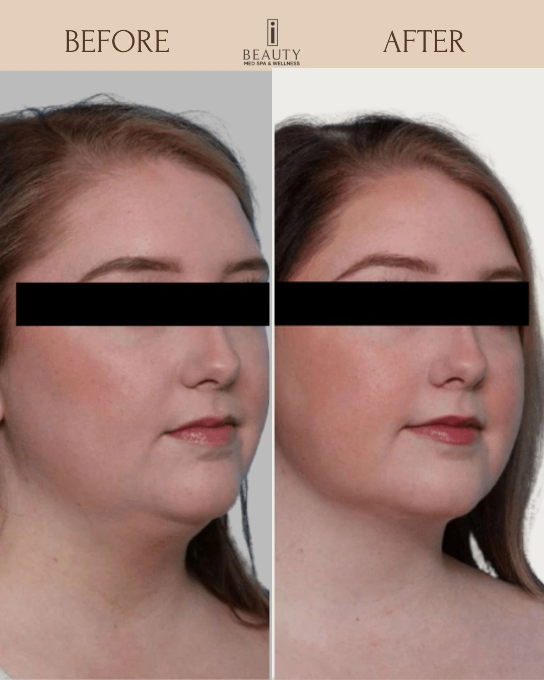 lipoai before and after